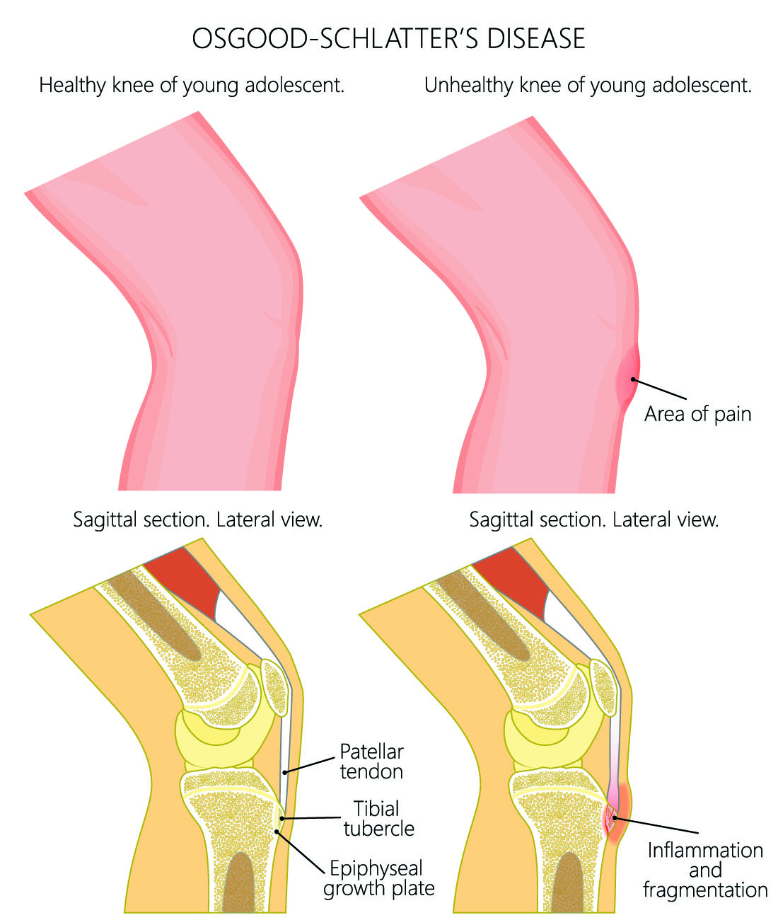 Can Osgood Schlatter Disease Affect Adults 